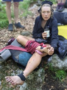 Mikaela Osler with injured feet.