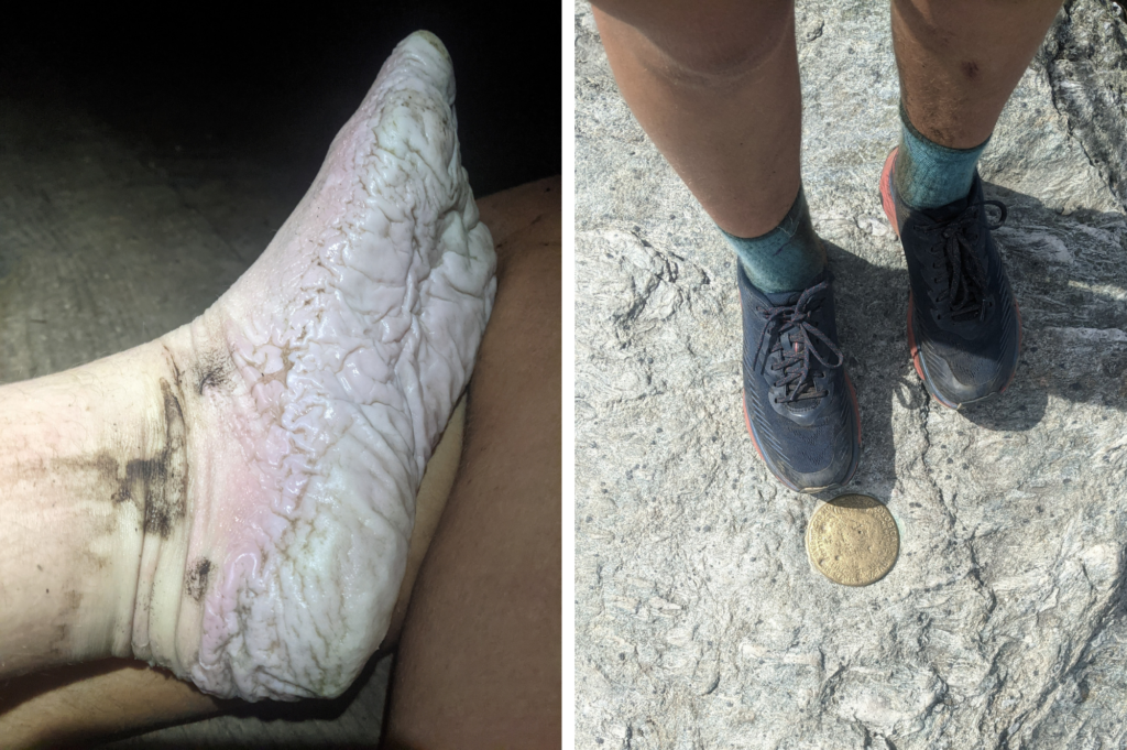 Trench foot (left) vs healthy feet in shoes (right); courtesy, Mikaela Osler